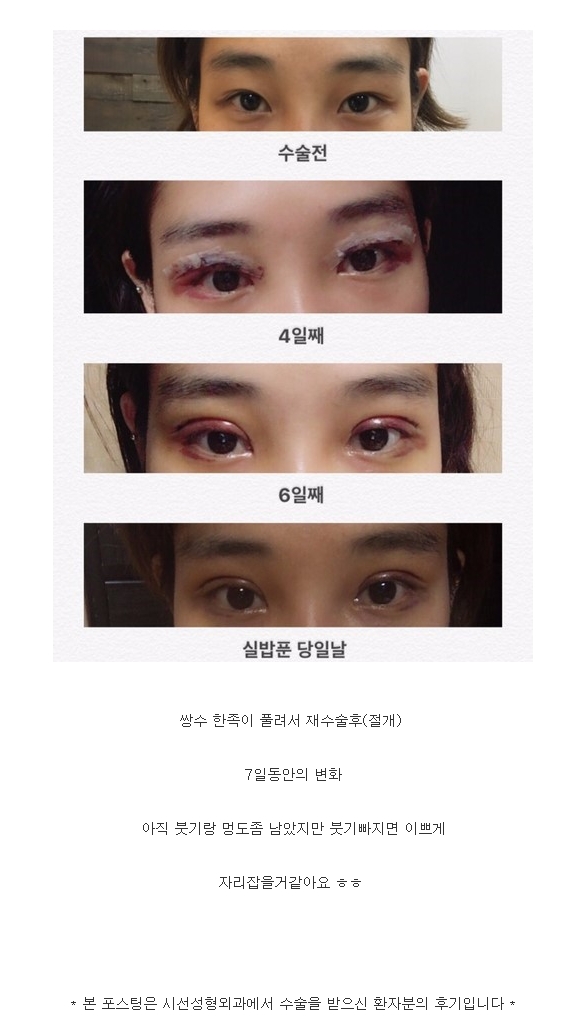 쌍수 풀려서 재수술후(절개)7일동안의 변화 > 실환자후기 | 눈재수술 시선성형외과