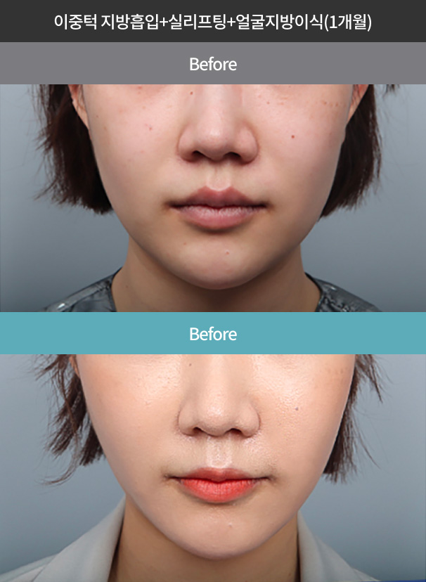 Before and one month after chin liposuction, thread lift and facial fat grafting
