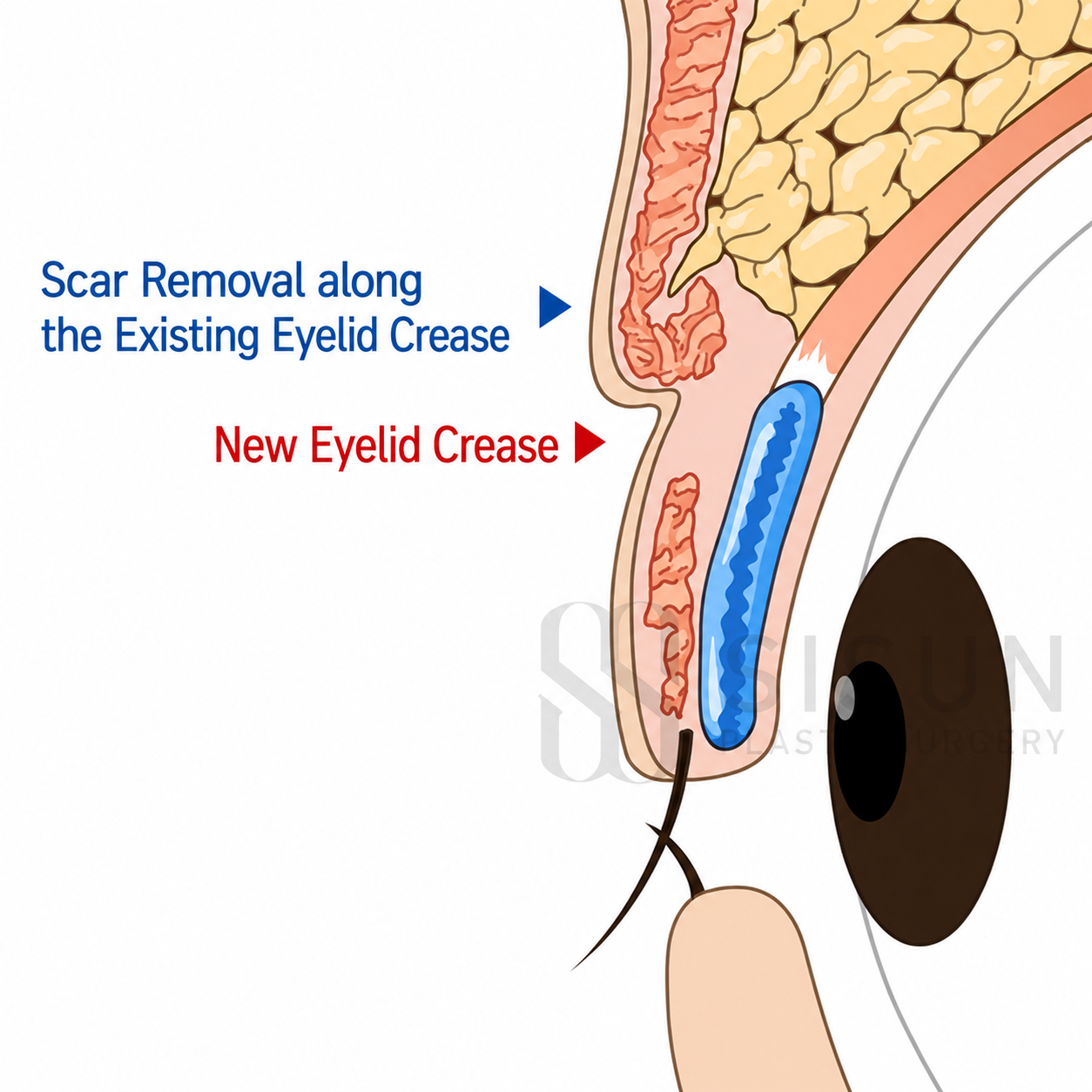 Existing crease scar removal